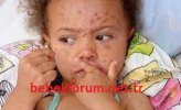 Measles in Children.jpg