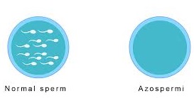 Azospermi.jpg