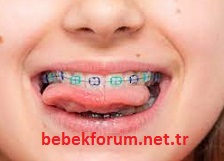 USE OF DENTAL BRACES IN CHILDREN.jpg